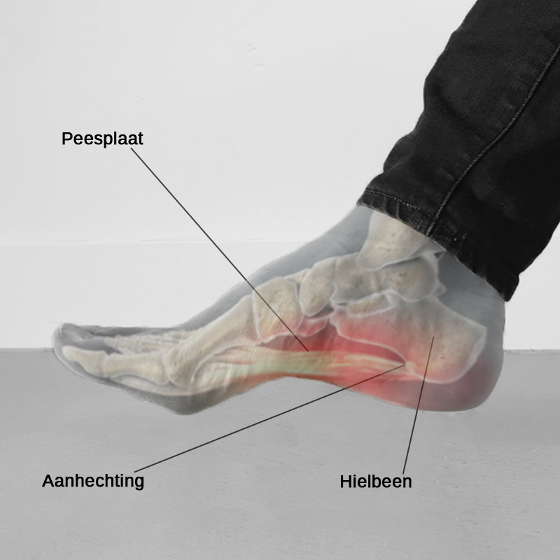 Hielspoor Uitleg En Oplossingen | De Hardloopwinkel Blog