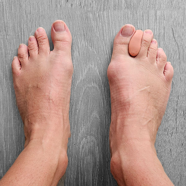 Hakken dragen na discount hallux valgus operatie